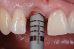 Fig 8. The 5-mm diameter trephine bur was engaged and then used to remove the palatal
portion of the remaining root.