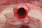 Fig 11. Occlusal view of the socket after removal
of the palatal segment of the root.
