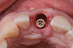 Fig 14. Occlusal view after placement of 3.3 mm x 12 mm
bone-level tapered implant.