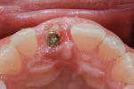 Fig 15. Small particles of xenograft were placed following healing
abutment placement.