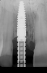 Fig 17. Periapical view with healing abutment
and temporary cylinder.