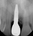 Fig 20. Periapical radiograph of
implant and final restoration 2
years postoperative.