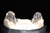 Figure 3  Radiograph of the poorly contoured implant restoration in Figure 2.