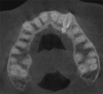 Fig 7. CBCT axial view demonstrating the supernumerary teeth and their orientation to the facial and palatal contours of the premaxilla.