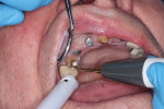 (1.) After removing the provisional bridge, any residual temporary cement was removed from the natural tooth abutments using an ultrasonic scaler.