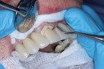 (6.) Immediately following the tack curing of the individual crown for tooth No. 8, cleanup of the excess cement resulted in most of it breaking off in one large piece.