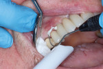 (7.) The individual crown for tooth No. 4 was delivered using a self-adhesive resin cement that does not require the use of a separate primer or adhesive.