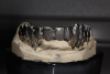 Figure 15  Final restoration of the replacement implants. Left central incisor and right and left lateral incisors were restored with individual tooth-supported single crowns.