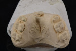 (8.) Occlusal view of the master cast demonstrating how the maxillary posterior teeth were prepared for survey crowns. The preparation design included minimal occlusal reduction given that the occlusal vertical dimension was increased and that the material of choice for the occlusal position was metal, with a metal lingual collar and a porcelain fused-to-metal design for the buccal contour.
