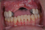 (11.) Retracted view of the survey crowns after delivery. The occlusal position was corrected as much as possible utilizing the crown design for bilateral balance. Note the parallel guide planes on the anterior most teeth, which are crucial components of the rotational path system that help prevent the need for an anterior clasp assembly.
