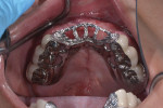 (13.) Retracted occlusal view of the rotational path framework seated intraorally over the survey crowns. Note that there is no anterior clasp assembly and that there is a press-fit design between the support, stability, and retention components built into the survey crowns.
