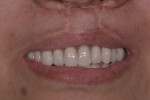 (15.) Smile photograph of the final removable partial denture seated intraorally on the survey crowns. The denture teeth were processed onto the framework using a high impact pink acrylic denture resin (Lucitone 199®, Dentsply Sirona) that was processed in a compression molding manner. Note how the lack of an anterior clasp assembly provides optimum esthetics.
