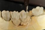 Figure 10  A dentin layer and translucency modifiers were applied to the titanium bridge substructure.