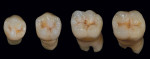 Figure 16  Technician-fabricated mandibular crowns from root to completion.