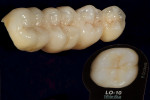 Figure 17  Matching natural occlusal stains begin with use of shade guide.