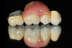 Figure 18  GC Gum pink porcelain was applied to the gum area of the bridge and fired a final time to completion.