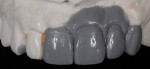 Figure 2  The diagnostic wax-up is the author's interpretation of what would need to be accomplished to restore the site and give the patient a natural smile.