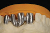 Figure 6  Defining the depth of implant placement. Implant placement may be at the osseous crest if there is sufficient buccolingual width at that location and sufficient restorative dimension (from the crest to the occlusal plane). However, if these requirements are not met, implant placement is planned in a subcrestal location with a need for accompanying alveolectomy.