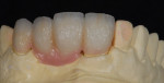 Figure 13  A custom "pink" ceramic material was created by the author to match the patient's natural gingival tissue.