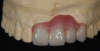 Figure 1 Normal overjet/overbite of anterior teeth