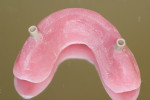 Figure 18  The topside of the maxillary basebar. Note that the bar-like ridge of light-cure material adds strength and rigidity.