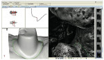 Figure 1  Photograph showing marking of the margins of the abutment in the laboratory, using the 3M™ Lava™ margin-marking software.