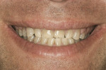 Figure 3  Close-up smile preoperative.