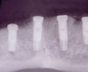 Figure 3  Periapical radiograph of implants in the Nos. 8 and 9 sites 3 years after placement. A bony peak was still present between the implants due to successful guided bone regeneration and favorable fixture spacing.