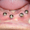 Figure 6  CT-derived fabrication of a surgical guide enabled proper fixture placement into the fresh extraction sockets.