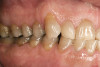 Fig 4. Screw-retained implant restoration after delivery.