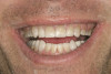 Fig 8. Final restorations showing good esthetic results and good soft-tissue integration.