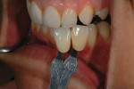 Figure 5  During the shade interview the author took basic shade photographs using standard manufacturer’s shade tabs to correctly match the veneers to surrounding natural dentition.