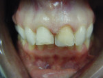 Figure 14  A diagnostic wax-up was created to communicate the author’s interpretation of the final result, and a photograph taken by the clinician at try-in.