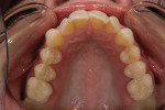 Figure 2  The distal rotation of the patient’s lateral teeth was the underlying cause for the over reveal of the canines.