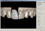 Figure 4  The full-contour design was completed to mimic the contours of tooth No. 9.