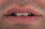 Figure 36  Try-in of the added correction to achieve the desired mesial length.