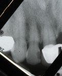 Figure 1  Preoperative radiographs show the splinted crowns, a large mesial bony defect on tooth No. 9, and failing mesial-lingual composite on tooth No. 10 with overhang and open contact.