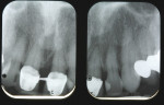 Figure 2  Preoperative radiographs show the splinted crowns, a large mesial bony defect on tooth No. 9, and failing mesial-lingual composite on tooth No. 10 with overhang and open contact.