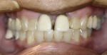 Figure 3  Preoperative photograph shows the diastema between teeth Nos. 8 and 9.
