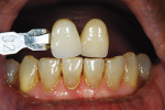 Figure 10  In the laboratory, custom shade photographs were taken. The goal was to match the natural lower anterior teeth and to create a natural blend with teeth Nos. 6 and 11.