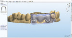 Figure 13  The models were scanned and the zirconia framework was simultaneously designed with the wax overlay.