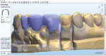 Figure 14  The models were scanned and the zirconia framework was simultaneously designed with the wax overlay.