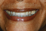 Figure 28  The restorations a week postoperative. The small gingival defect can be seen, as well as the patient’s low smile line. The shade match to the lower anteriors and the blending with the upper cupsids were regarded by the patient, dentist,