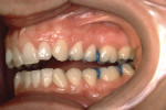 Figure 4  Intra-oral photograph of the left buccal dentition displaying an open bite and Class II Division I malocclusion. The only occlusal contacts are on the distal buccal cusps of the second molars.
