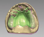 Figure 7  Buccal clasp arms are designed to the desired contour and shape.