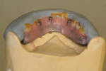 Figure 17  Flowing molten wax is used to bond teeth to the bar as well as to fill in previously approved contours and tooth length carves.