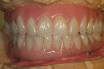 Figure 22  Ivoclar Phonares nanohybrid composite denture teeth—completely reset and waxed onto titanium bars for final full try-in.