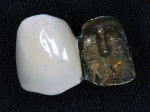 Figure 3  Early attempts at creating esthetic materials resulted in silicate and acrylic resins that were veneered to gold substructures.