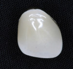 Figure 5  Porcelain-fused-to-metal (PFM) restorations came on the scene in the 1960s.