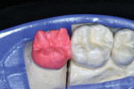 Figure 9  The dentin was applied to occlusal/lingual surfaces.
